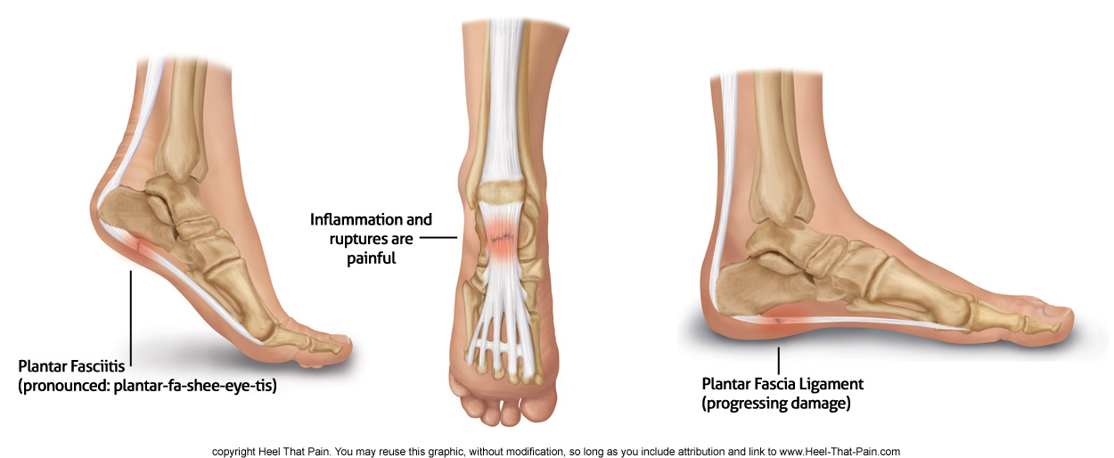 Plantar Fasciitis Injection Complications