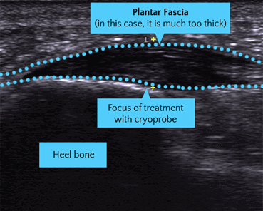 Plantar Fasciitis Treatment Ultrasound