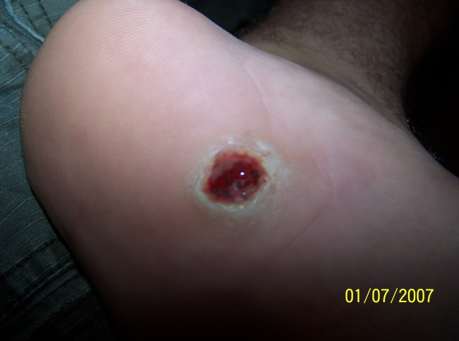 Plantar Wart Removal Surgery Recovery