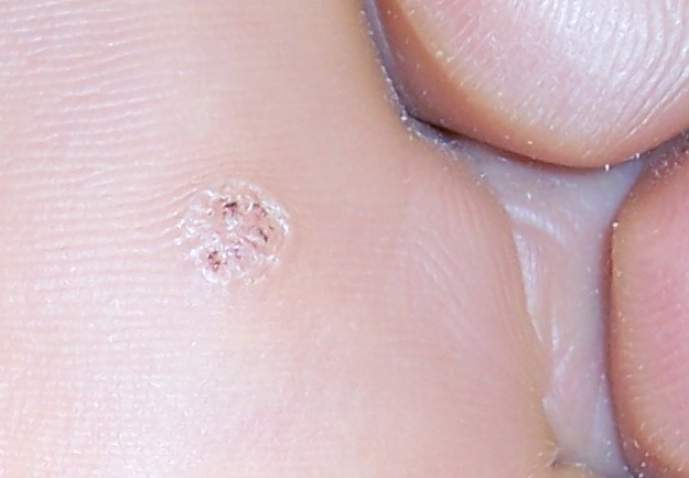 Plantar Wart Root Pictures