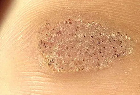Plantar Wart Root Pictures