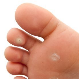 Plantar Warts On Feet Home Remedy